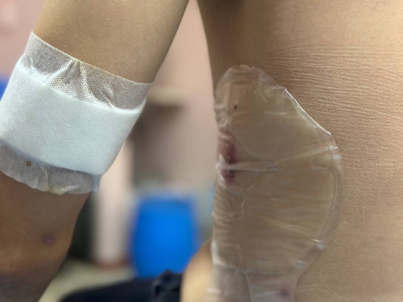 Напряженный пневмоторакс в бою: почему счет идет на секунды